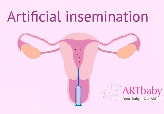 options for Artificial Insemination : pictorial rep