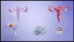 What is IVF? Image