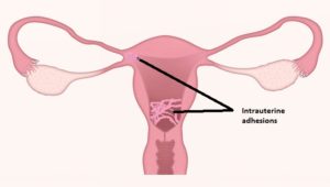 intrauterine adhesion: Asherman syndrome